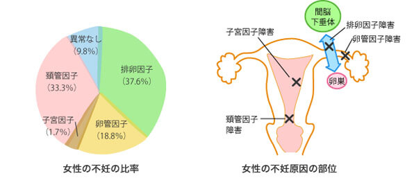 不妊症の原因（女性）