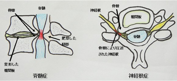 頚椎症