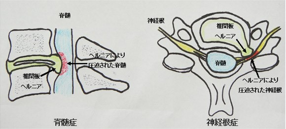 頚椎症