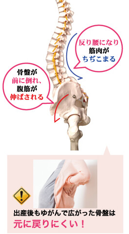 出産後もゆがんで広がった骨盤は元に戻りにくい！