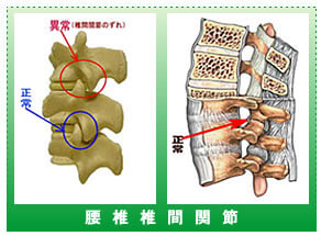 椎間関節症
