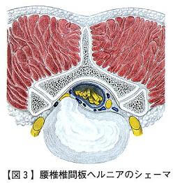 腰椎椎間板ヘルニア