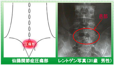 二分脊椎症